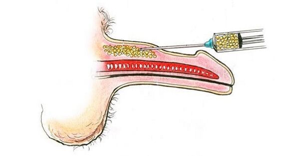 Ενέσεις υαλουρονικού οξέος στο βαρέλι ενός μέλους προκειμένου να το αυξήσει